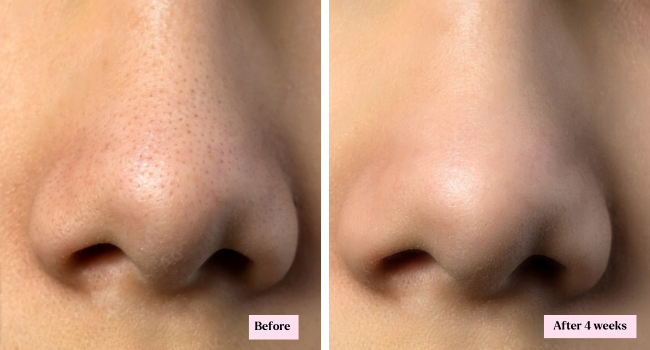 Facial Steamer Spa Kit with Complimentary 17 Skin Care Tools | Face Steamer for Facial Deep Cleaning with Towel Warmer & Humidifier Mode| Self Care Gifts for Women, Spa Gifts, Birthday Gifts for Women